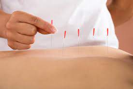 Dry needling is an invasive procedure where a fine needle or acupuncture needle is inserted into the skin and muscle.